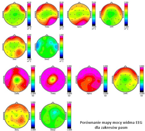 Mapy mózgu w neuroobrazowaniu EEG